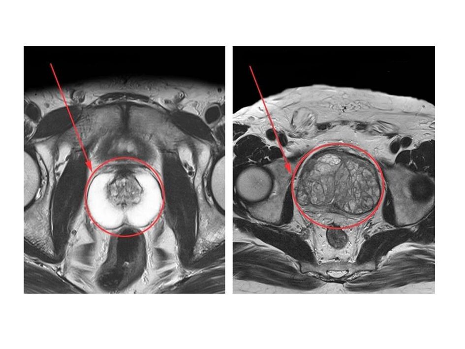 Σύγκριση υγιούς (αριστερά) και φλεγμονής (δεξιά) προστάτη σε εικόνες μαγνητικής τομογραφίας